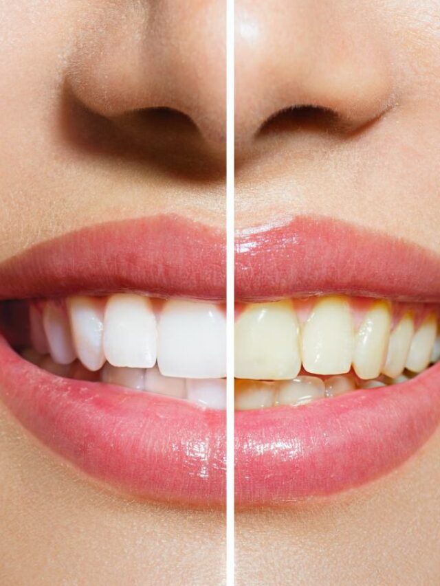 दांतों के पीलेपन से न हों परेशान, बस अपनाएं ये घरेलू नुस्खे